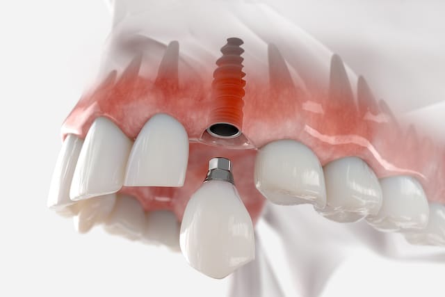 dental implant